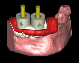 Implantate