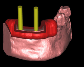 Implantate