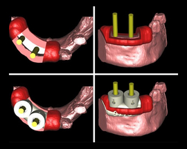 Implantate