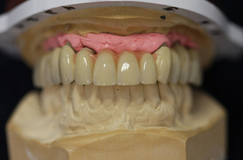 Zahnersatz metallfrei, PEEK Teleskope, Zirkon-Abutments