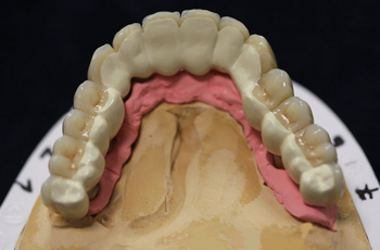 Zahnersatz metallfrei, PEEK Teleskope, Zirkon-Abutments