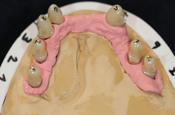 Zahnersatz metallfrei, PEEK Teleskope, Zirkon-Abutments